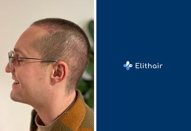 Aufnahme von Christopher L. kurz nach dem Eingriff bei Elithair.