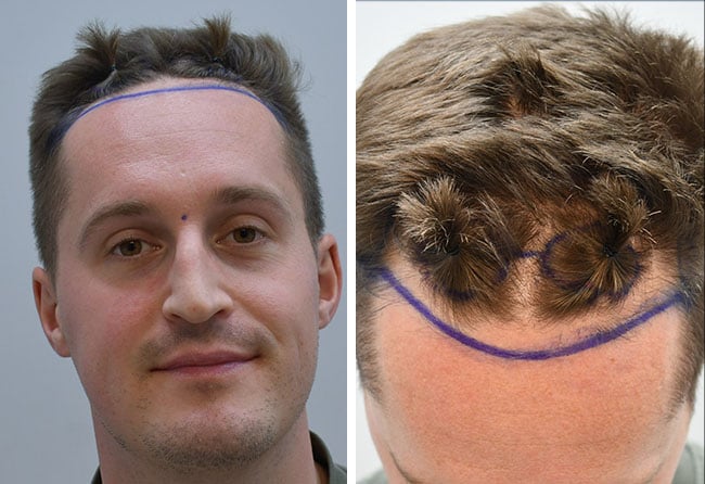 Vorheraufnahme von Christopher L. mit eingezeichneter Haarlinie zur OP-Planung – Vorbereitung der Haartransplantation bei Elithair