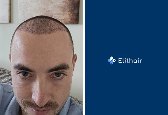 Aufnahme von Marcel Z. kurz nach der Haartransplantation bei Elithair – frisch implantierte Grafts im Bereich der Geheimratsecken