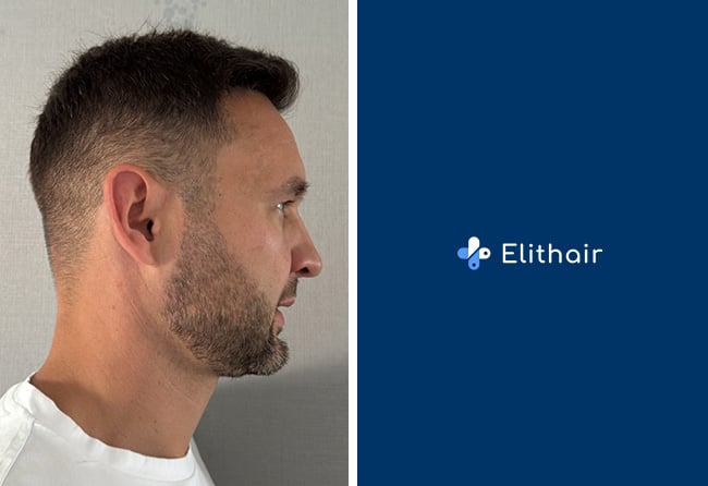Nachher-Aufnahme von Alexander B. nach seiner Haartransplantation bei Elithair
