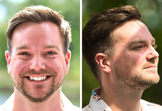Bilde des Elithair-Patienten Achim K.– sichtbar dichteres und volles Haar nach der Haartransplantation