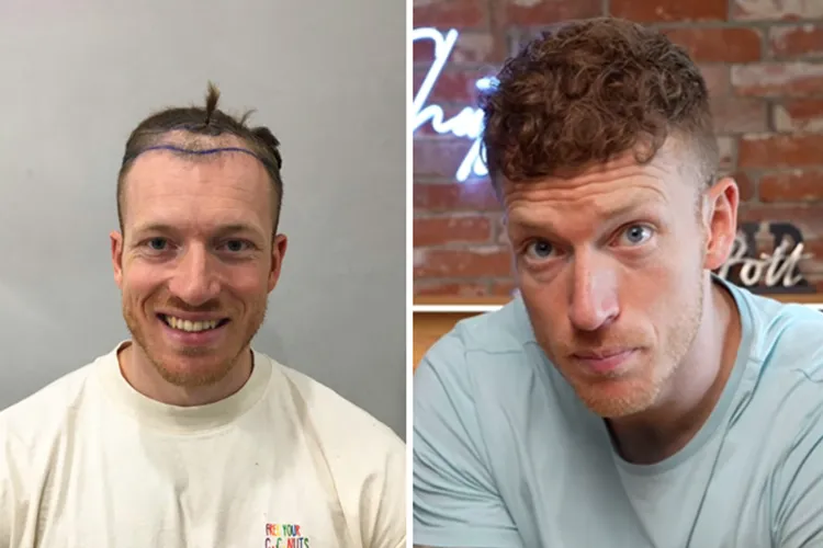 Vorher-Nachher-Bild des Patienten Schmale Schulter vor und nach einer Haartransplantation bei Elithair
