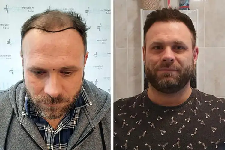 Vorher-Nachher-Bild von Elithair-Patient Michael Woulfe nach einer Haartransplantation