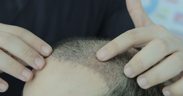 Haartransplantation Grafts Spielen Eine Wichtige Rolle