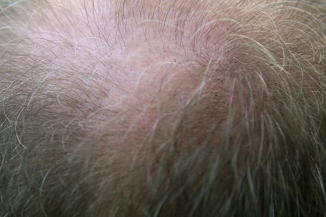 Nahaufnahme eines männlichen Kopfes mit Haarausfall.