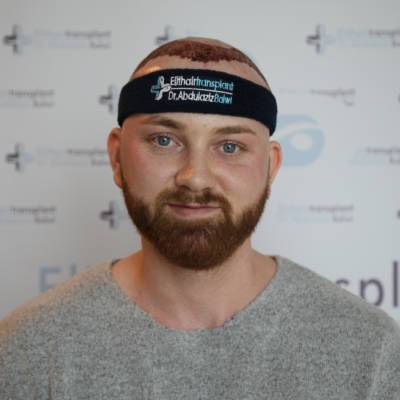Haartransplantation Türkei Erfahrungen