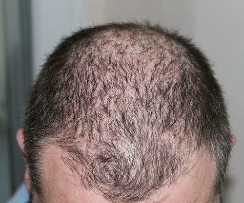 Ursachen von Haarausfall und lichtes Haar bei Männer 