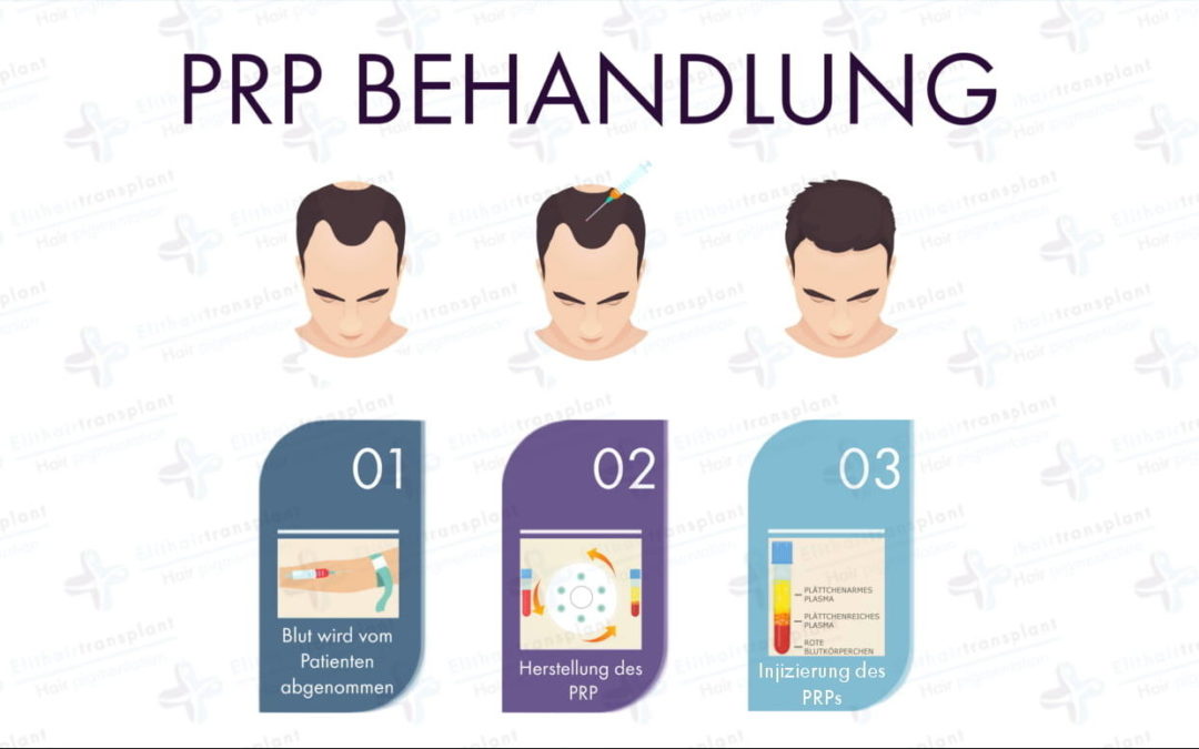 Alternativen der Haartransplantation