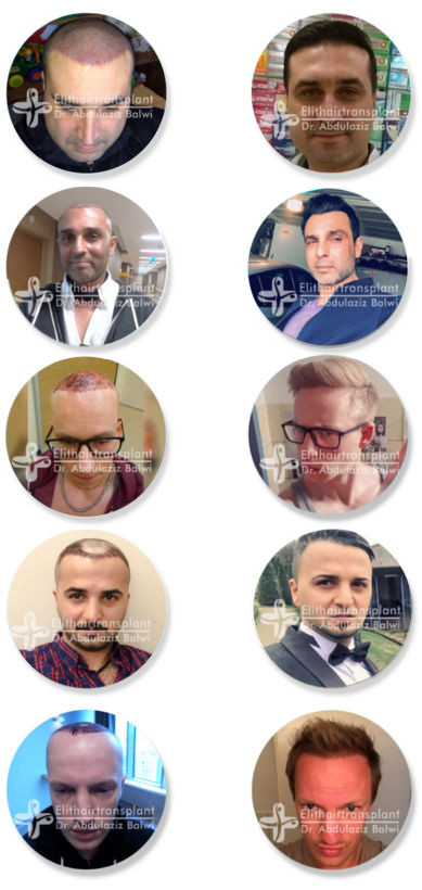Haartransplantation Türkei - Nachher Haartransplantation Türkei - Nachher