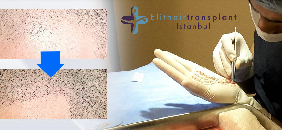 Minimalinvasive Haartransplantation