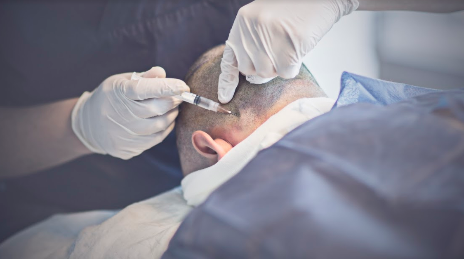 Spenderbereich nach Haartransplantation