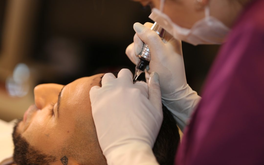 Was hilft bei Haarausfall -Transplantation oder Pigmentierung?