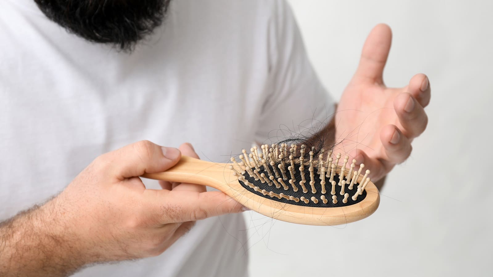 Androgenetische Alopezie