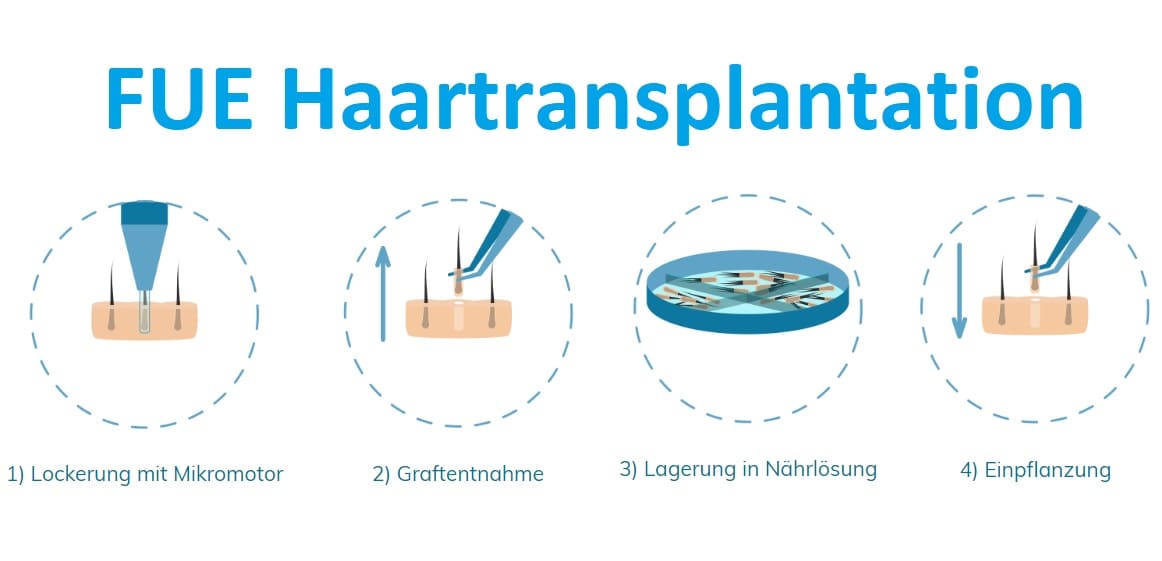 Manuelle Haartranaplantation FUE Technik Manuelle Haartranaplantation - FUE Technik