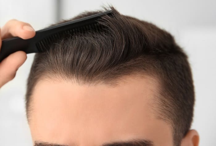 Haartransplantation Planung -Aussehen nach der Haarverpflanzung Haartransplantation Planung -Aussehen nach der Haarverpflanzung