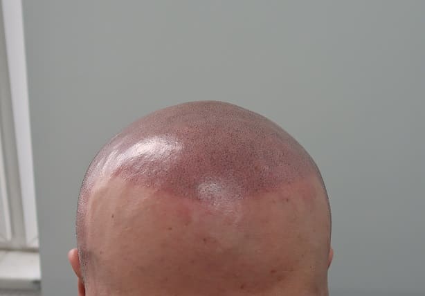 Ist Die Haartransplantation Auch Bei Einer Glatze Moglich