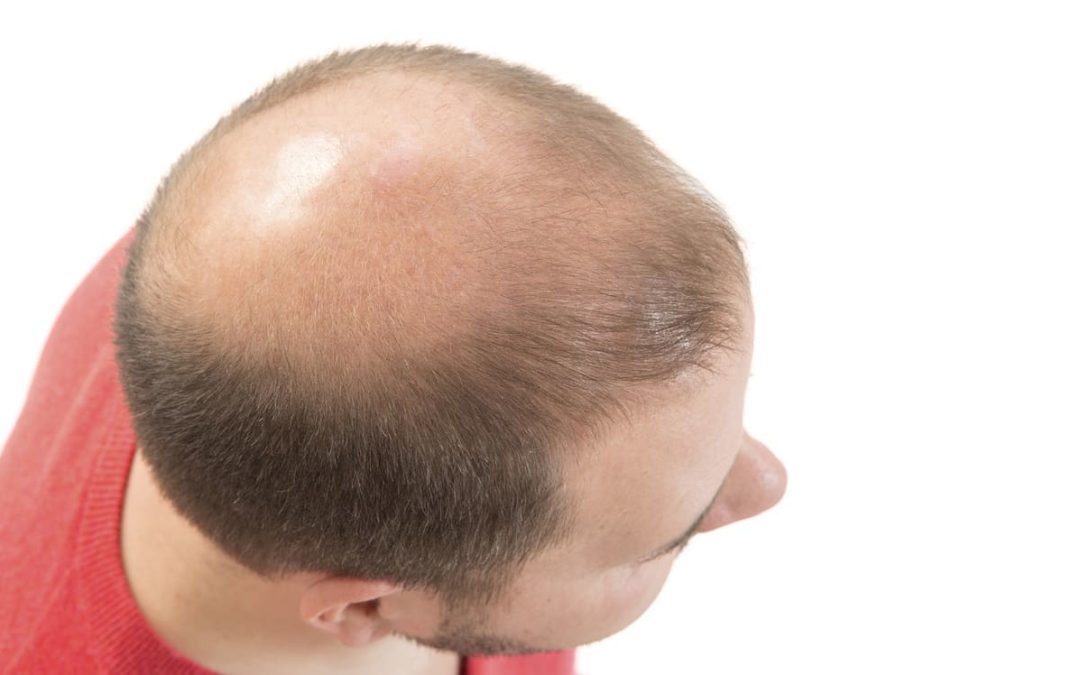 Mechanischer Haarausfall und seine Folgen