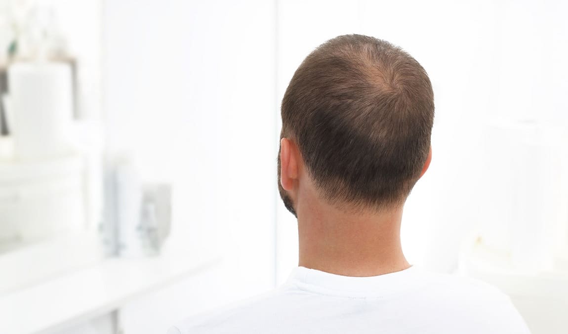 Dunnes Haar Beim Mann Wodurch Wird Der Haarverlust Begunstigt