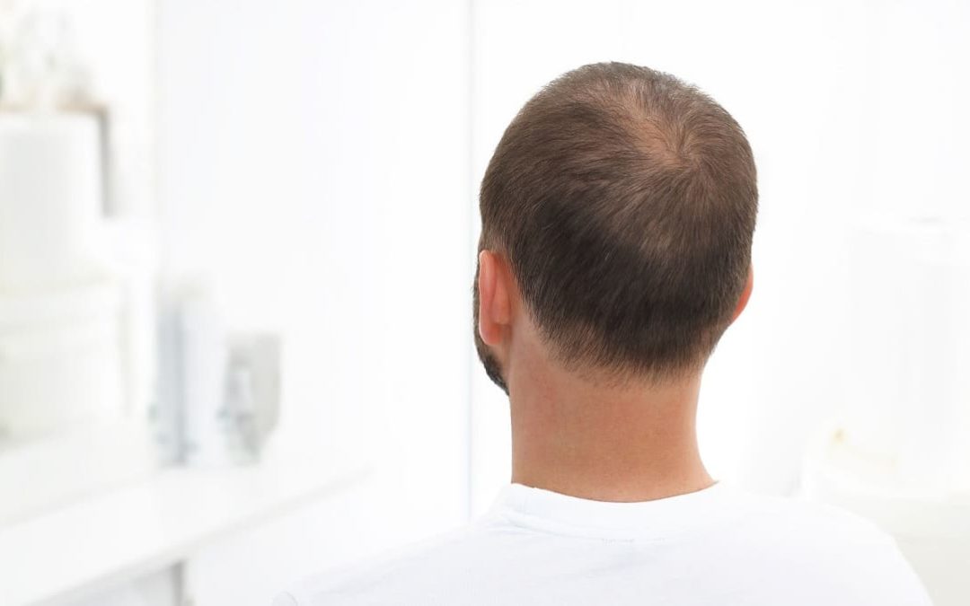 5 verschiedene Gründe für dünnes Haar beim Mann