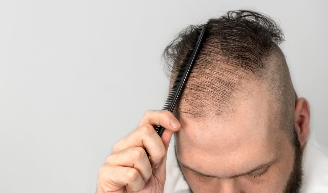 Durch eine Autoimmunerkrankung verursachter Haarausfall