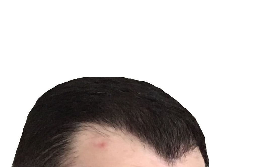 Haartransplantation: Pickel an der Tagesordnung?