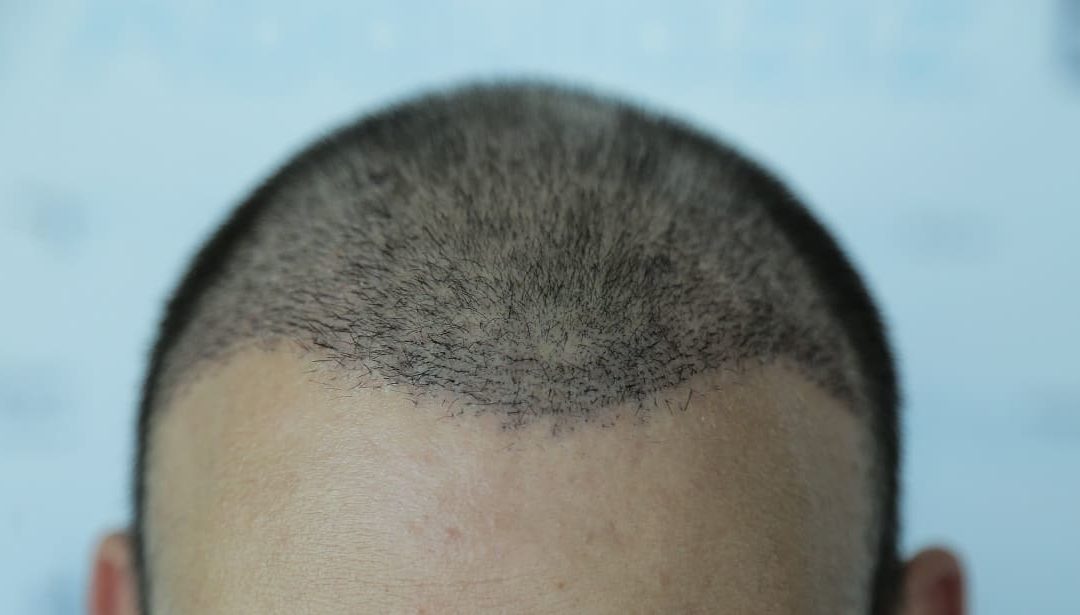 Haartransplantation: Haare fallen wieder aus. Ist das normal?