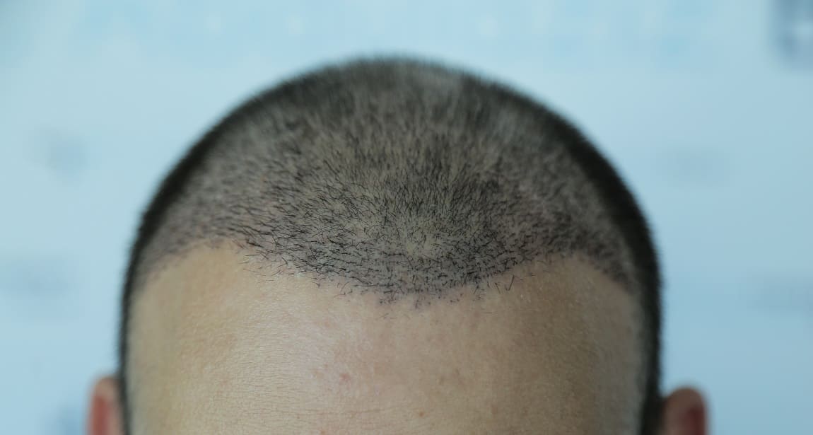 Nach Der Haartransplantation Warum Fallen Die Haare Wieder Aus