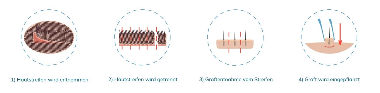 Narbenkorrektur Nach Der Fut Technik Haartransplantation