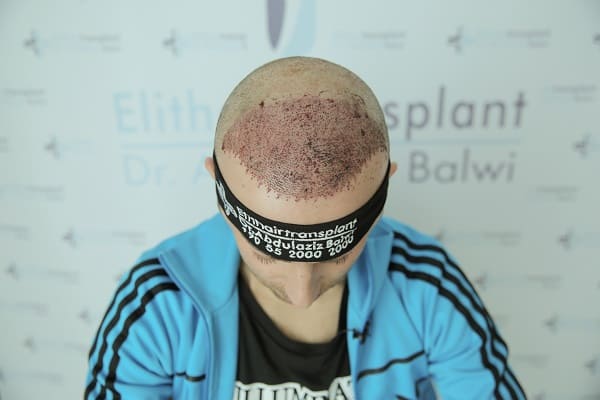 Haarverpflanzung kann bei Haarausfall durch Färben helfen
