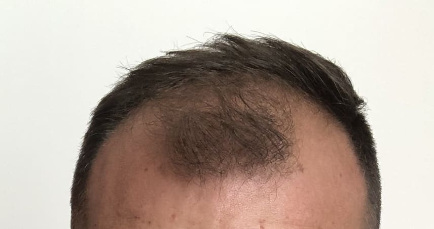 Arganöl gegen Haarausfall