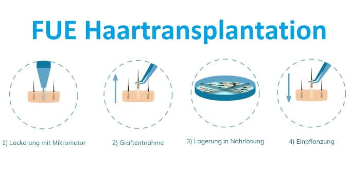 Manuelle Haartranaplantation FUE Technik Manuelle Haartranaplantation - FUE Haartrabsplantation