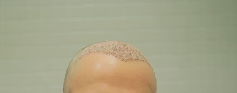 Haarausfall durch seelische Belastung - Eine Haartransplantation hilft dagegen