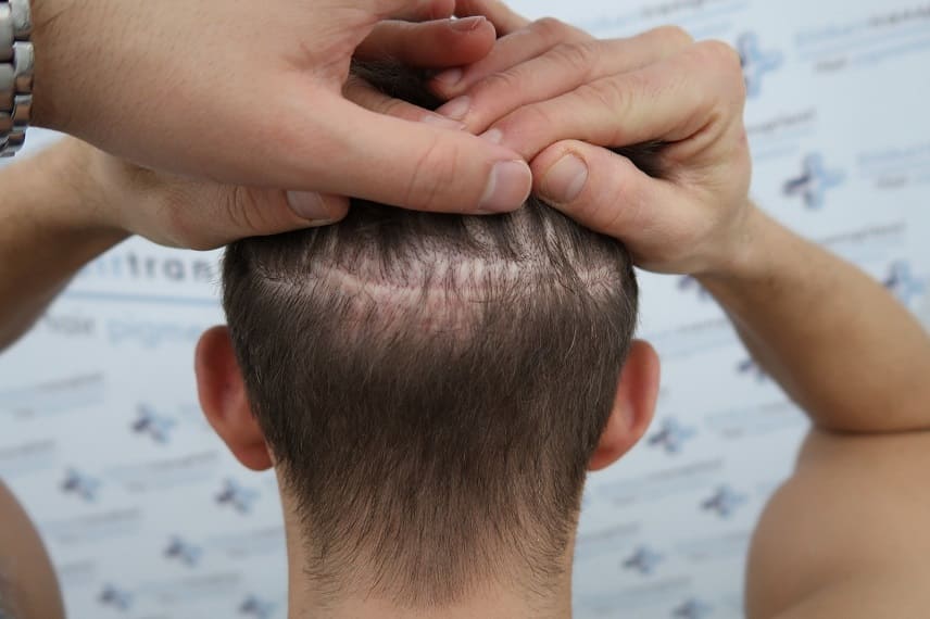 Haartransplantation Bei Narben Behandlungsmethode Vorhanden