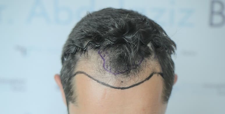 Haaransatz beim Mann - gezeichnete Haarlinie vor der Behandlung