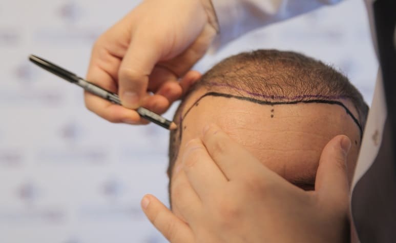 Haaransatz beim Mann - Dr. Balwi zeichnet natürliche Haarlinie