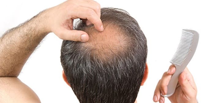 Kopfhauterkrankungen mit Haarausfall von Tonsurbereich