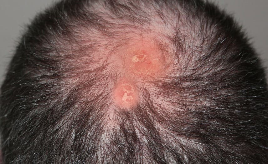 Folliculitis Decalvans Therapie Gegen Haarausfall Moglich