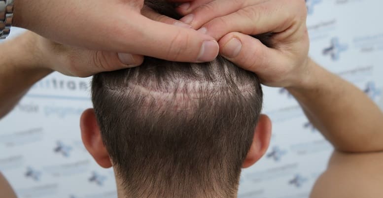 Haartransplantation Methoden Risiken Preise Berlin De