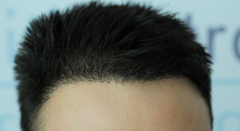 Haarausfall durch bakterielle Infektion - Neues Haarwachstums nach Haartransplantation