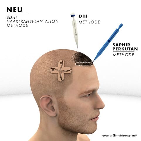 DHI Methode - Eine revolutionäre Idee DHI Methode - Eine revolutionäre Idee auf Gebiet Haartransplantation