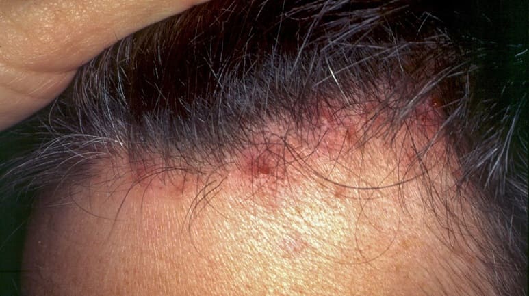 Folliculitis decalvans Therapie - Pickel auf Kopfhaut