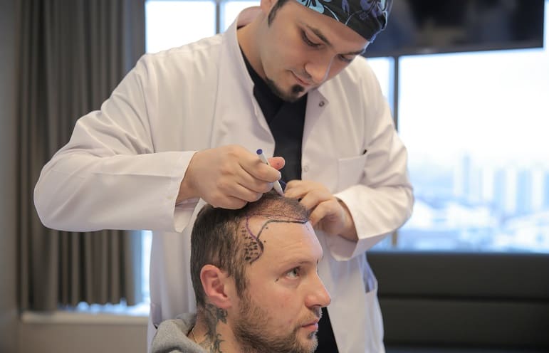 Dr. Balwi zeichnet die natürliche Haarlinie Begriffserklärung Geheimratsecken - Dr. Balwi zeichnet die natürliche Haarlinie
