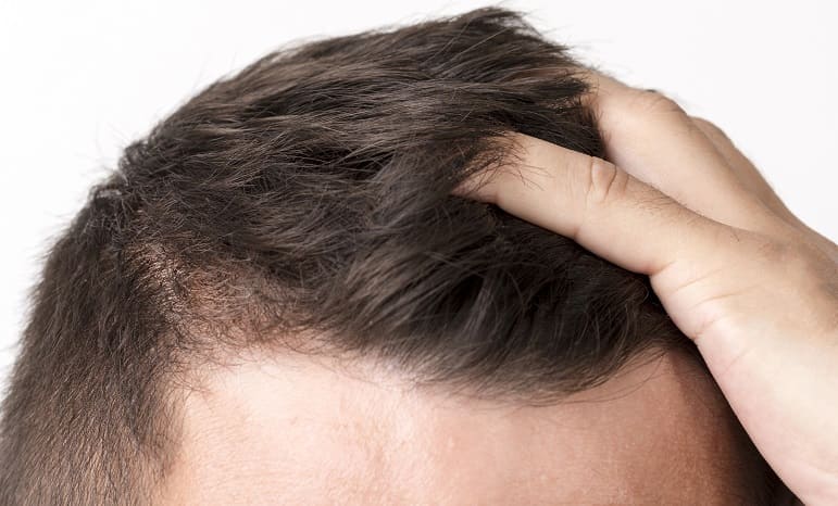 Männer vorher nachher regaine Haarausfall
