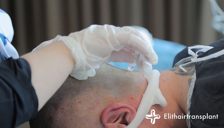 Haartransplantation unter Vollnarkose - lokale Anästhesie