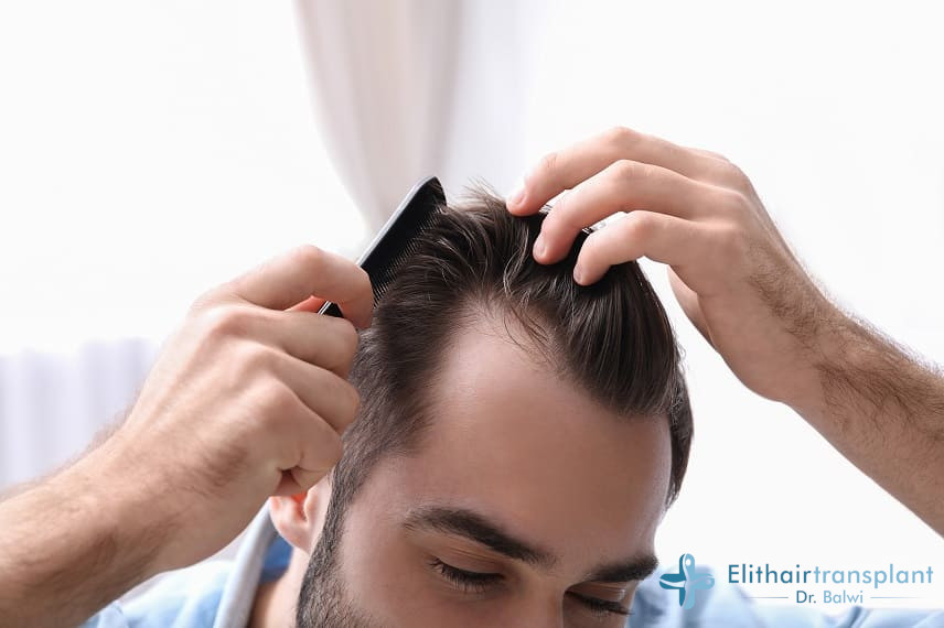 Was ist Alopecia Androgenetica?