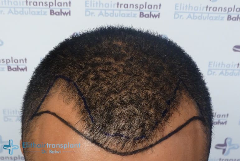 Gezeichnete natürlichen Haarlinie vor der Haartransplantation bei fortschreitendem Haarausfall