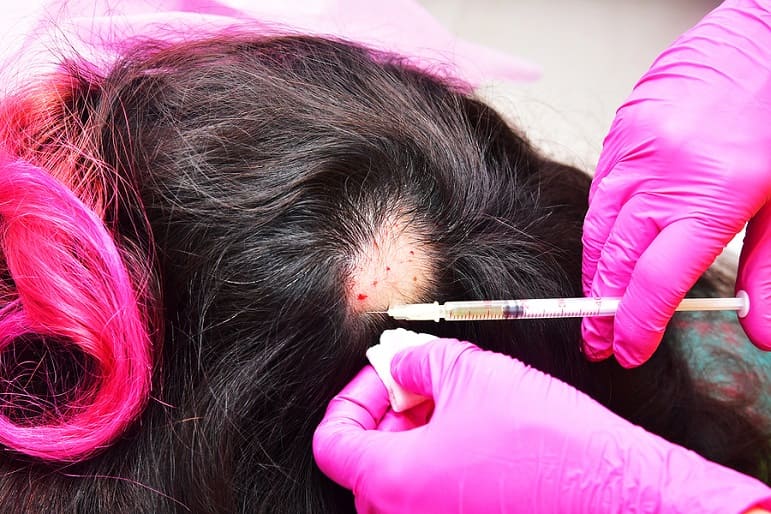 PRP Behandlung bei kreisrundem Haarausfall