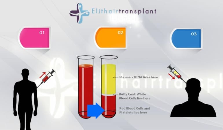 Ablauf der PRP-Behandlung bei Elithairtransplant