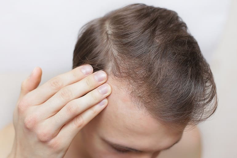 Junger Mann prüft mit seinen Fingern seinen Haarausfall