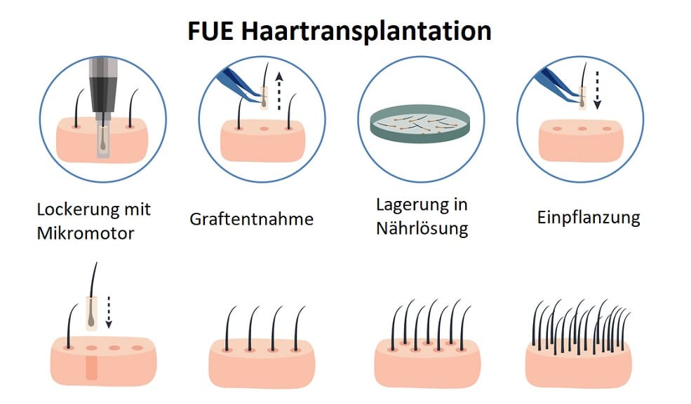 Plantur 21 Erfahrungen die passende Lösung bei Haarausfall?